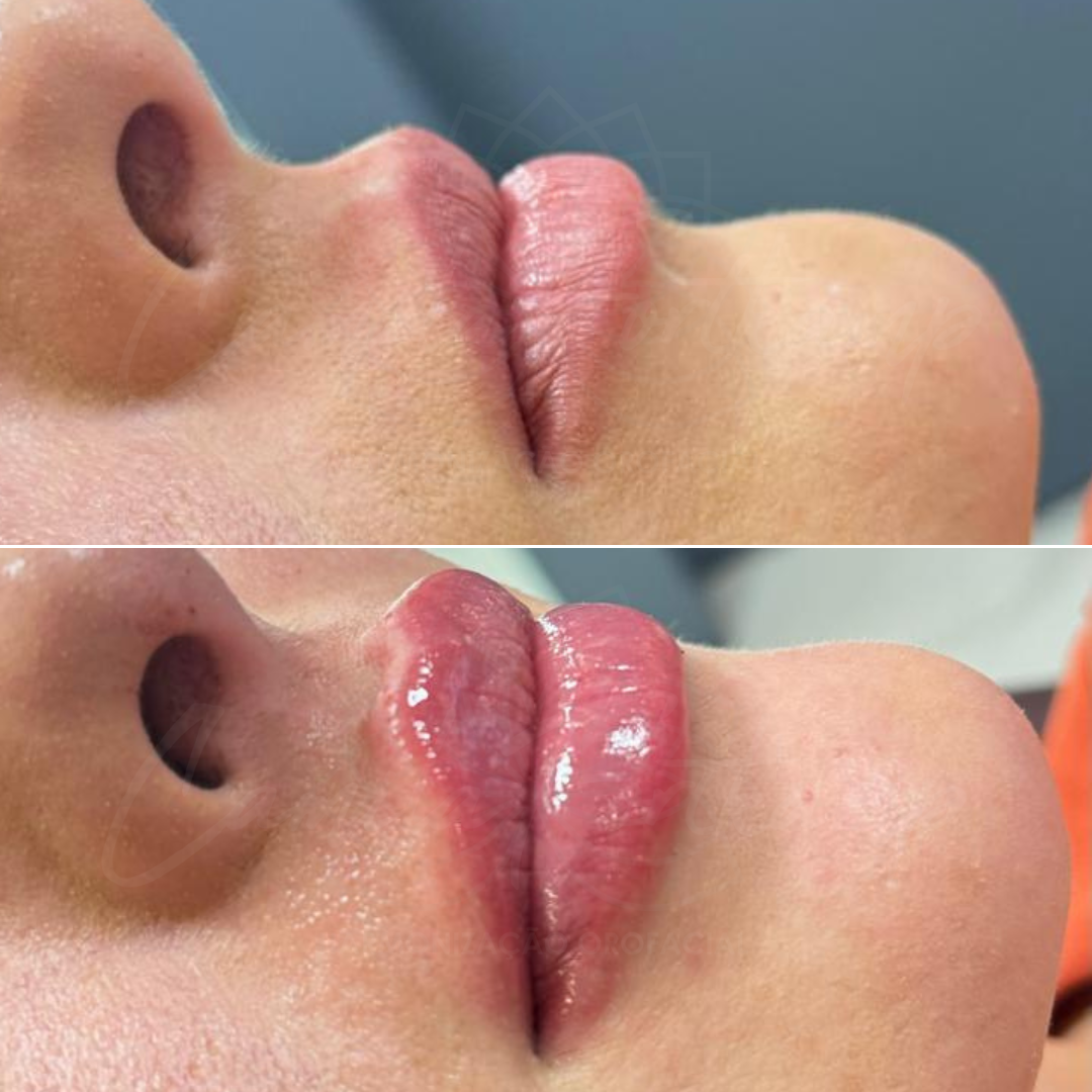 Harmonização Orofacial